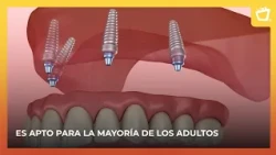 Do you need a dental prosthesis? Learn about the All-on-4 treatment