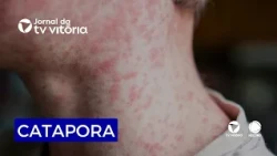 Chickenpox cases on the rise in the South