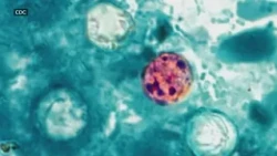 Cyclospora cases increase in NC; here's how to protect yourself