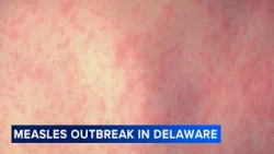 Measles outbreak declared in Delaware; cases also rising in Chester County, Pa.