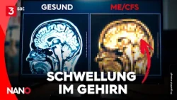 ME/CFS: New Research Findings | NANO