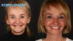 Czy implant może się nie wgoić? Lekarz odpowiada 🦷🤔 | Bez kompleksów