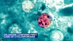Delaware confirms first case of cyclosporiasis