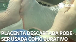 Placenta discarded during childbirth can be used as a dressing in treatment available through the...