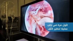 إجراء عملية تنظير كتف لأول مرة في مشفى  حلب الجامعي