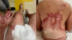 Jovem suspeito de incendiar rapaz durante confraternização em Lagamar é preso preventivamente
