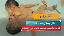 Conjoined twins with two heads and one body in Sana'a.. Can they be separated?