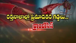 రక్తనాళాల్లో ప్రమాదకర గడ్డలు... థ్రాంబోసిస్‌ | Sukhibhava | ETV Life