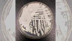 Drug-resistant fungus Candida auris spreading across US, doctor says healthy people face low risk