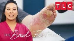 Extreme Pedicures | The Bad Foot Clinic | TLC