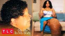 Living Beyond Rare Diagnoses | One Day in My Body | TLC