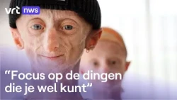 Michiel (28), who had the aging disease progeria, has passed away