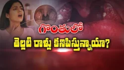 గొంతులో తెల్లటి రాళ్లు కనిపిస్తున్నాయా? | Do you see white stones in your throat? | Sukhibhava