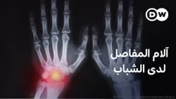 لماذا تزداد آلام المفاصل بين الشباب؟ | صحتك بين يديك