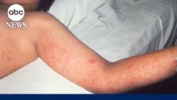 New measles death reported in Pennsylvania