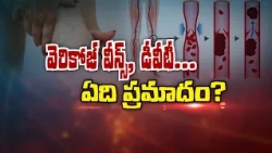 వెరికోజ్ వీన్స్, డీవీటీ ఏది ప్రమాదం? | Varicose veins, DVT... Which one is dangerous?| Sukhibhava