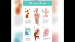 Rota virus može dovesti do ozbiljnih komplikacija kod dece